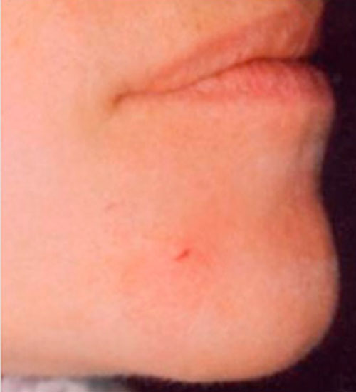 Dermal and tissue fillers